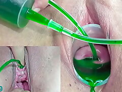 Cervix and Pee Hole Inflation with Injections for Asian Lesbos